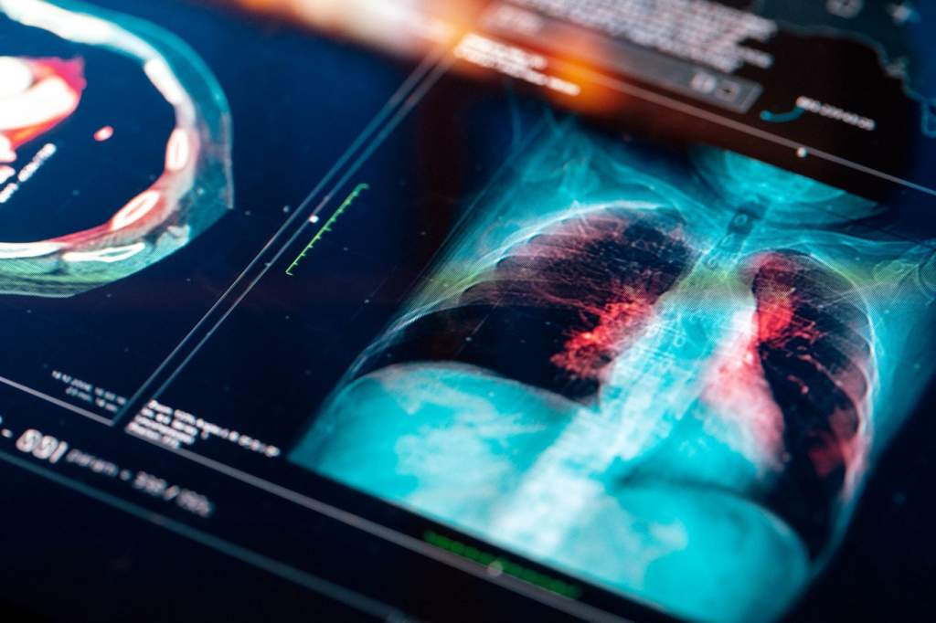 Alacsony dózisú ingyenes CT-vel a tüdőrák ellen
